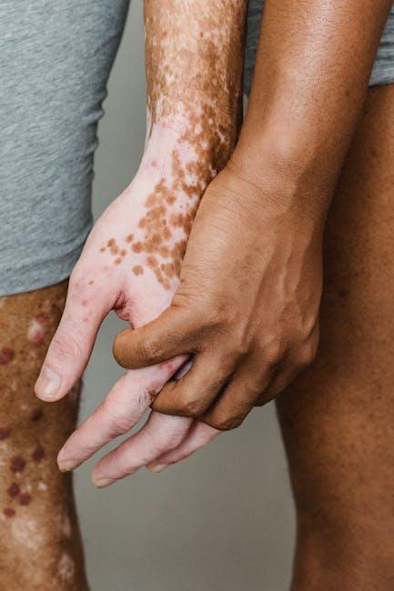 psoriasis triggers